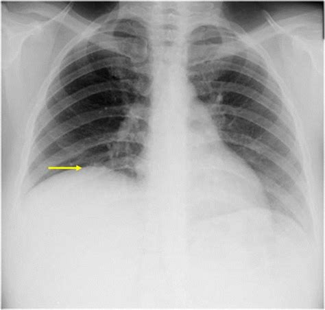 The chest radiograph dem- A chest radiograph at this time showed eleva- onstrated an elevated right hemidiaphragm. . What does mild elevation of the right hemidiaphragm mean